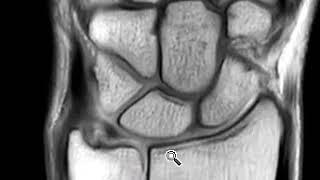 TFCC tear and ulnar collateral ligament complex tear [upl. by Loreen]