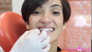 Applicazione Faccette Dentali  Torino [upl. by Josselyn]