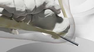 Minimally Invasive Plantar Fasciitis Heel Spur Surgery [upl. by Qiratla]