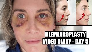 Blepharoplasty Video Diary  Day 5 After Surgery 4 of 15 [upl. by Ramoh]