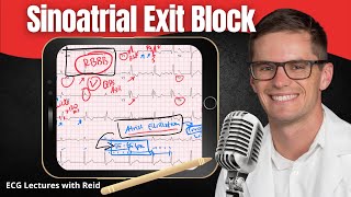 Sinoatrial SA Exit Block EKG  ECG Lecture [upl. by Drannek47]