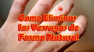 Como Eliminar las Verrugas del Cuello de la Cara las Manos de forma Natural [upl. by Eenolem443]