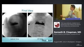 Vertebroplasty and Kyphoplasty Lecture Dr Chapman [upl. by Aniar]