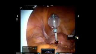 Uterine Manipulator Perforaration in Endometrial Cancer Robotic [upl. by Otanod726]