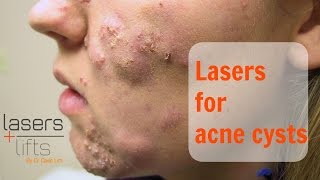 Treating acne cysts [upl. by Jepson]