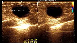 Multiple Simple Breast Cysts  Breast Nodules  Cystic Mass [upl. by Marduk]