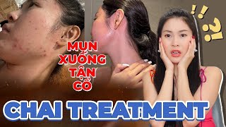 Mình đã trị sạch mụn nổi xuống tận cổ khi bị CHAI TREATMENT như thế nào ❗❓ [upl. by Oicnedif]