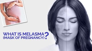 What is Melasma Mask of Pregnancy  Melasma Causes and Treatment Explained  3D Animation [upl. by Dlnaod]