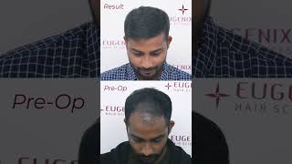 Hair Transplant Before After Your transplanted hair is permanent [upl. by Eldoree818]