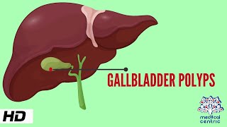 Gallbladder Polyp Causes Signs and Symptoms Diagnosis and Treatment [upl. by Danas]