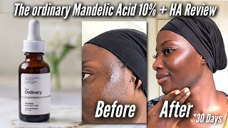 THE ORDINARY MANDELIC ACID 10  HA INDEPTH REVIEW [upl. by Annaoy656]