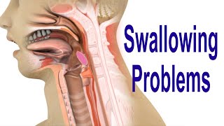 Swallowing Problems or Dysphagia Top 4 Possible Causes Including Cricopharyngeal Dysfunction CPD [upl. by Humble]