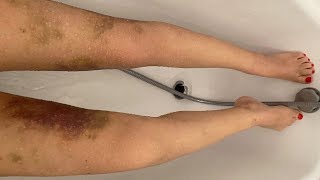 Mes jambes 10 jours après lopération du lipoedème VLOG 12 [upl. by Ahearn]