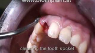 IMMEDIATE IMPLANT  INCISOR  NO DRILLING  FLAPLESS  LIVE VIDEO [upl. by Areit490]