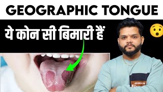 Geographic Tounge Cause Symptoms amp Treatment In Hindi [upl. by Nodnrb966]