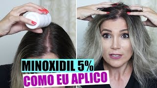 COMO APLICAR MINOXIDIL  NÃO RESSECA O CABELO [upl. by Lladnyk]