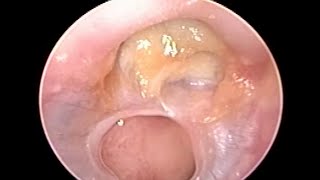 Safe as well as Unsafe Ear Disease CSOM in Same Ear on Otoendoscopy [upl. by Hedvah648]