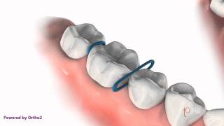 Orthodontic Spacers [upl. by Floro]