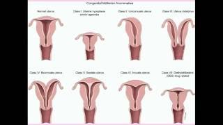 Congenital Uterine Abnormalities  CRASH Medical Review Series [upl. by Hamlani]