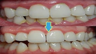 How to Remove Teeth Plaque Naturally at Home Best Remedies for Teeth Plaque Removal [upl. by Dnalyr761]