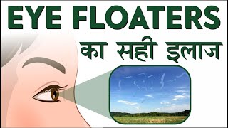 Eye Floaters  Cause amp Treatment  Risks amp Management of Eye Floaters आई फ्लोटर्स को कैसे ठीक करें [upl. by Ru765]