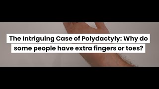 The Intriguing Case of Polydactyly Why do some people have extra fingers or toes [upl. by Dorie55]