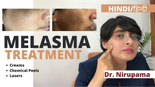 Melasma Treatment Melasma Treatment cream Melasma treatment laser Melasma treatment in Hindi [upl. by Palua190]