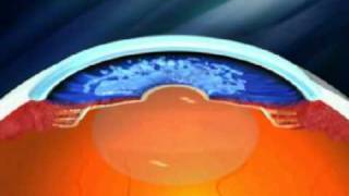 Advance Glaucoma Treatment  Canaloplasty [upl. by Orv]