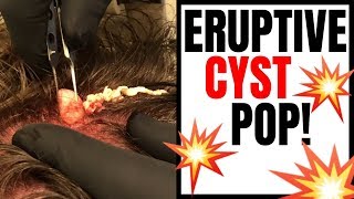 ERUPTIVE CYST POP [upl. by Amles]