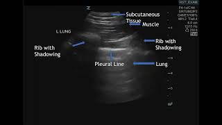 Thorax Scan Technique [upl. by Lyrred172]