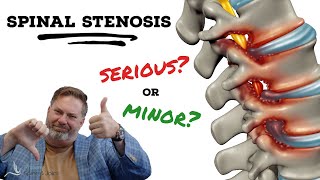 Is Spinal Stenosis serious  The Clinic Episode 1 [upl. by Silyhp]