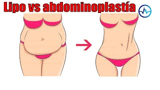 DIFERENCIAS entre ABDOMINOPLASTÍA y LIPOSUCCIÓN 🌹 DR ALBERTO CALVO 👸 MEDICINA EXTRAORDINARIA [upl. by Corell]