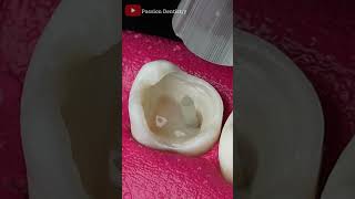 Incredible Dental Bridge teeths satisfying [upl. by Ivon]