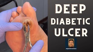 DEEP Diabetic Foot Ulcer podiatristfoot and ankle specialist treats a foot ulcer [upl. by Eerahs301]