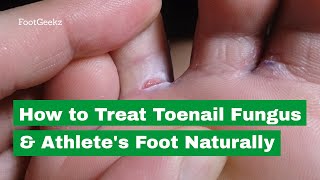 BEST Athletes Foot Fungus Treatments HOME Remedies  BIG SECRETS PT2 [upl. by Ynatil991]