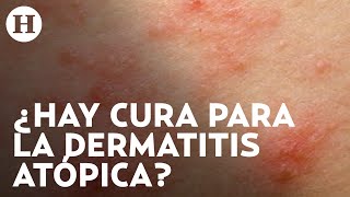 Dermatitis atópica Qué la causa cuáles son los síntomas y qué tratamientos hay  Médico H [upl. by Annahaj599]