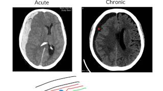 Subdural haemorrhage [upl. by Hak]