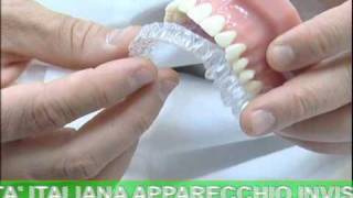 ODONTOIATRIA Invisalign  Apparecchio Invisibile [upl. by Halehs15]