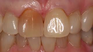 How to whiten single discoloured tooth  Dentist in Skelmersdale [upl. by Riley]