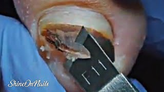 Black Toenails Trimming PedicureExpertsFootCareSpecialistsToenailHealthExpertsNailCareTips [upl. by Gambrell]