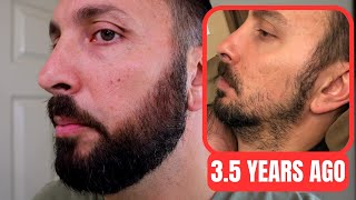 Minoxidil Beard Journey 35 Years Later  How To Grow A Real Beard [upl. by Sirroned481]