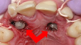 Awful IMPACTED canines  BEFORE and AFTER BRACES time lapse [upl. by Acessej]