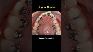 Lingual braces transformation braces orthodontist bracket [upl. by Oneg]