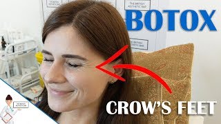 Botox For Crows Feet  Full Procedure With Results [upl. by Milka]