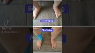 Taping for Out Toeing footpain kinesiologytape kttape taping outtoeing [upl. by Nneb]