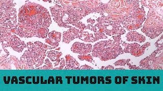 Vascular Tumors of Skin 31 cases in 3 hours Board Review for Pathology Dermatology Dermpath [upl. by Yajeet865]