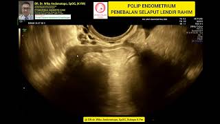 Polip Endometrium [upl. by Aicemat]