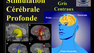 Stimulation Cerebrale Profonde maladie de parkinson tremblements [upl. by Orabla]