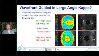 Laser Eye Surgery Topography or WavefrontGuided TransPRK Vs LASIK Vs SMILE Vs ICL [upl. by Ainitsirhc533]