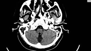 CASE 348 CT BRAIN LACUNAR AND BASAL GANGLIA INFARCTION ATROPHIC CHANGES [upl. by Zanas]